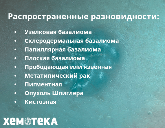 Разновидности базалиомы Разновидности базалиомы