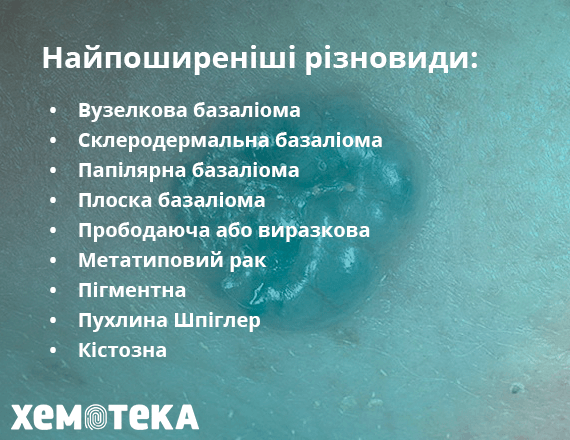 Різновиди базаліоми Різновиди базаліоми