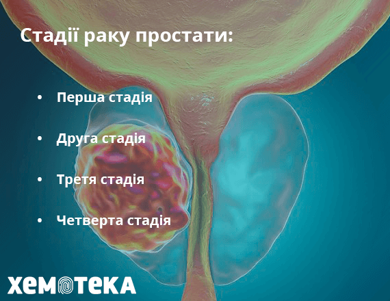 Стадії раку простати Стадії раку простати