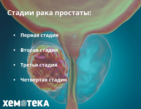 стадии рака стадии рака