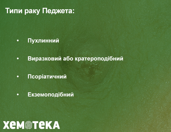 типи раку Педжета типи раку Педжета