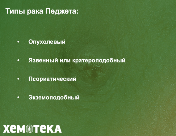типы рака Педжета типы рака Педжета