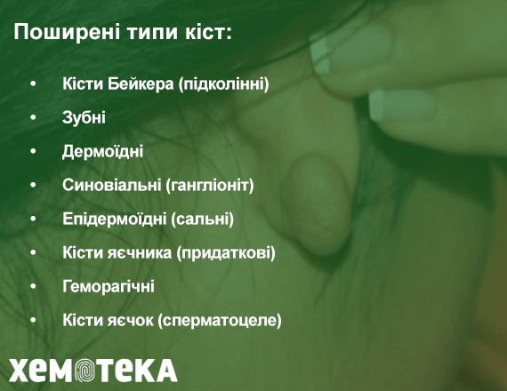 Типи кіст Типи кіст