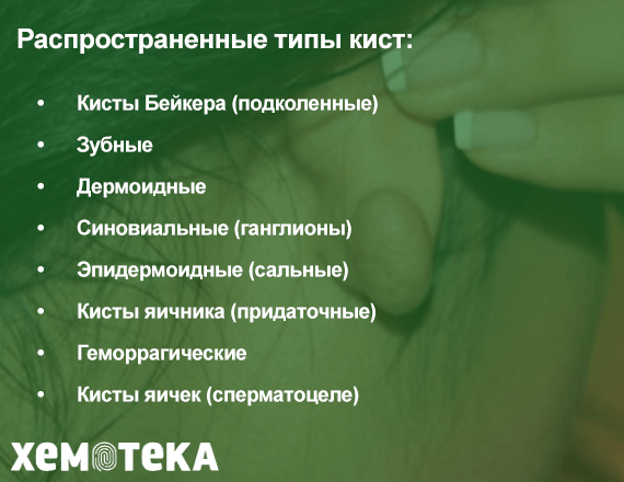 Типы кист Типы кист