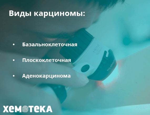 Виды карциномы Виды карциномы