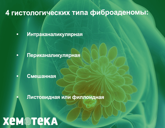 типы фиброаденомы типы фиброаденомы