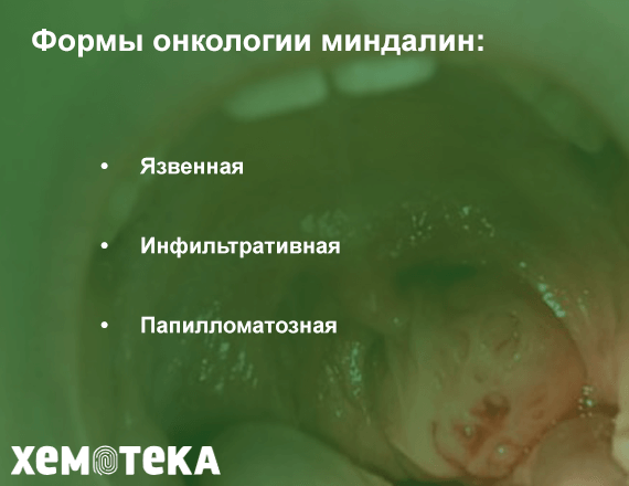 формы онкологии миндалин формы онкологии миндалин